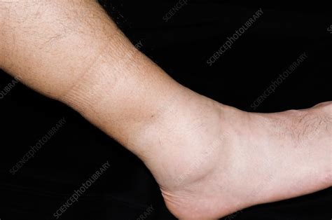 Swollen Ankle In Hypertension Stock Image C0090083 Science Photo
