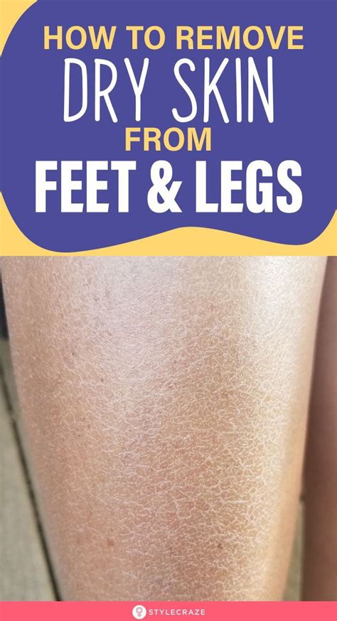 How To Remove Dry Skin From Your Feet And Legs In 2020 Natural Skin