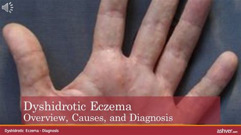 Dyshidrotic Eczema Overview Causes And Diagnosis Diagnosis