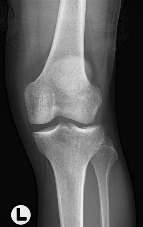 Lateral Tibial Plateau Fracture Xray