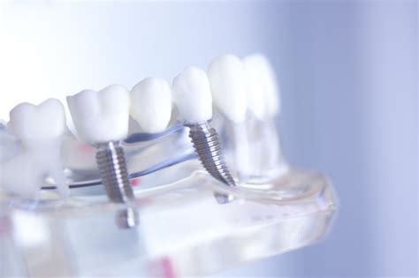 Implantes Dentales En Barbastro Clínica Dental Barbastro