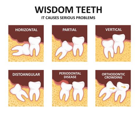 How Long For Wisdom Teeth Removal Pain Tutorial Pics