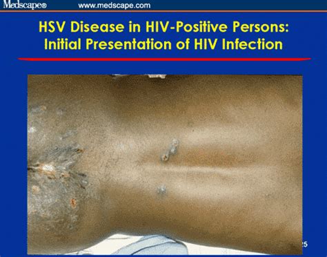 Herpes Simplex Virus 2 In Hiv Coinfected Patients Prevention
