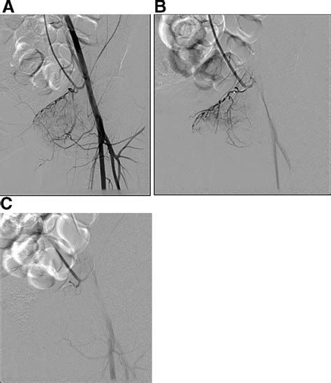 A Selective Left External Iliac Artery Angiogram Showing The High