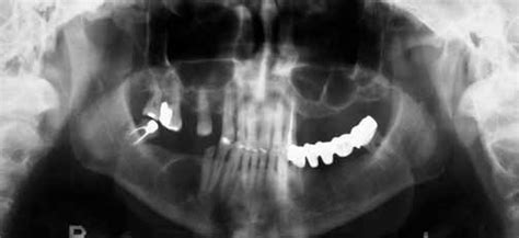 Residual Cyst Panoramic View Of The Mandible Reveals A Corticated