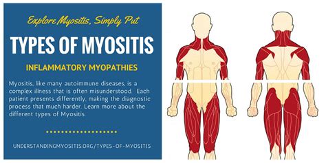 Types Of Myositis Myositis Support And Understanding