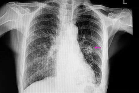 What Exactly Is A Lung Nodule Step To Health