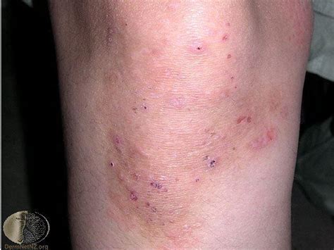 Dermatitis Herpetiformis Clinical Photo Dermatology Grepmed