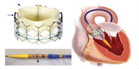 Edwards Sapien Percutaneous Heart Valves Bovine Perica Open I