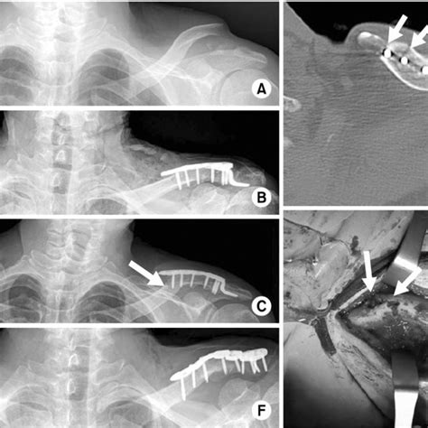 Pdf Periprosthetic Fracture After Hook Plate Fixation In Neer Type Ii