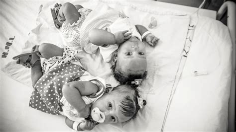 Adorable Photos Reveal Conjoined Twins Successfully
