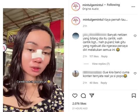 Seleb Tiktok Popo Barbie Nekat Oplas Hidung Demi Tampil Cantik