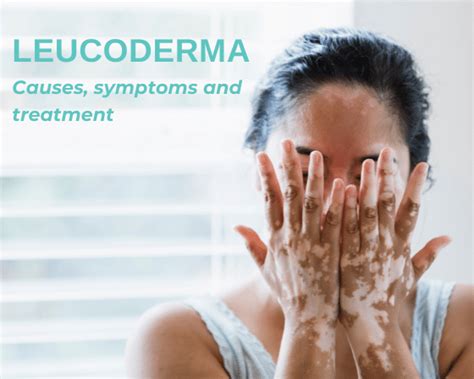 Leucoderma Causes Symptoms And Treatment Sprint Medical
