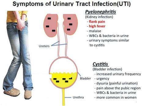 A Urinary Tract Infection Overview Doctor Tipster