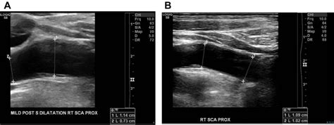 Evaluation And Management Of Arterial Thoracic Outlet Syndrome