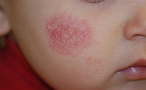 Dermatite Seborroica Cause Rimedi E Cura Della Dermatite Seborroica