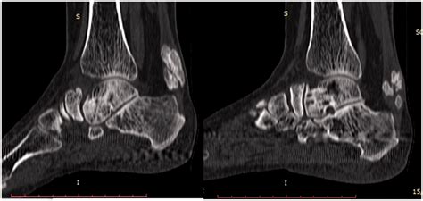 Ossification of the bilateral Achilles tendon: a rare entity - Abhishek