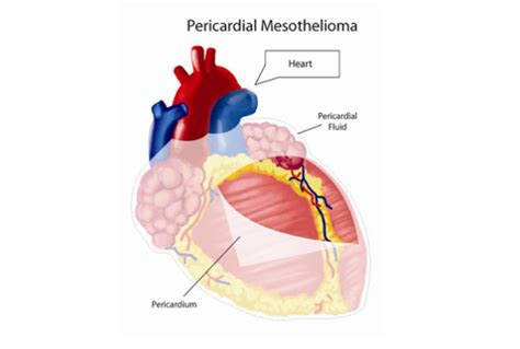 Pericardial Mesothelioma Signs Causes Treatment X Mesothelioma2
