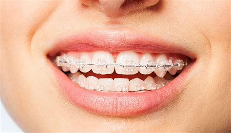 Eating with braces can be tricky. What can't you eat with braces? | iSmile Orthodontics ...