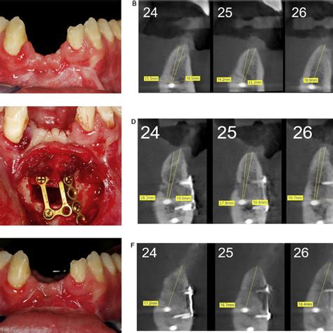 Pdf Vertical Alveolar Ridge Augmentation In The Anterior Maxilla And