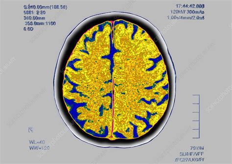 Brain Scan Stock Image C0129761 Science Photo Library