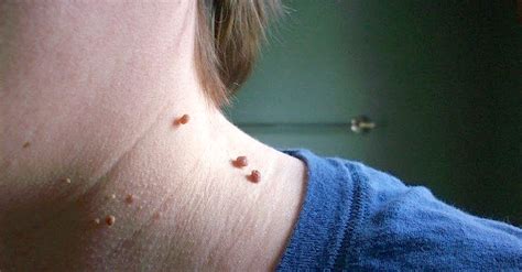 she had skin tags on her neck until she removed them with this i had no idea