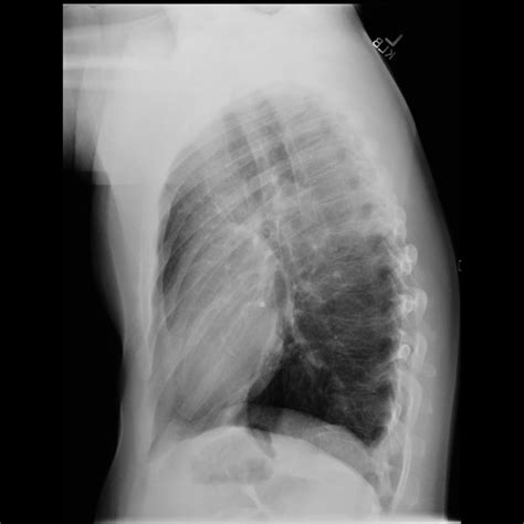 Chest X Ray Normal Cxr Lungs