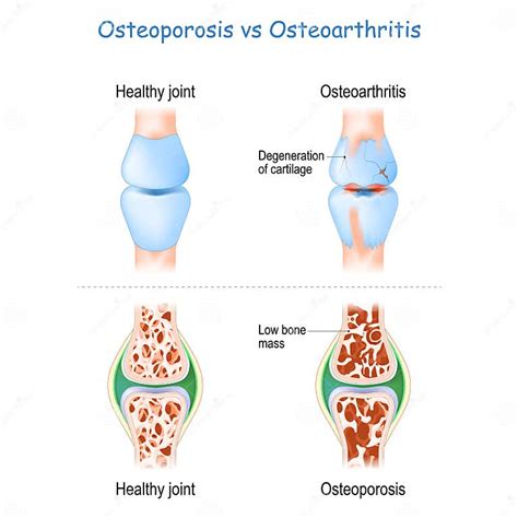Osteoporosis Vs Osteoarthritis Stock Vector Illustration Of Cross Surgery 224531237
