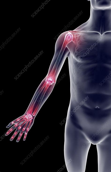 Arm Joint Pain Stock Image C0081507 Science Photo Library
