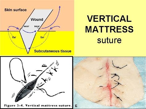 Suturing Basics Topics Sutures Knots Wounds Classification Healing