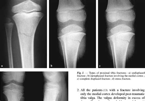 Cozens Fracture Post Traumatic Tibial Valga The Alfred I Dupont