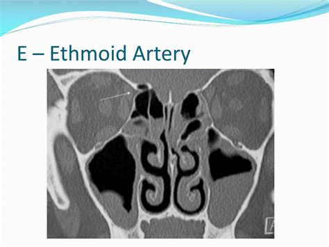 Ppt Principles Of Functional Endoscopic Sinus Surgery Powerpoint