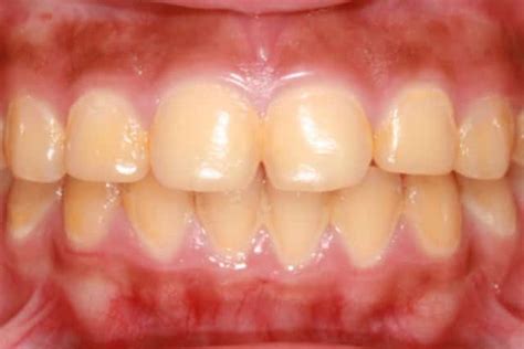 Deep cleans mouth, between teeth, and along the gum line to gently remove stains & plaque. Yellow Teeth, Stains, Pictures, Causes, Prevention ...