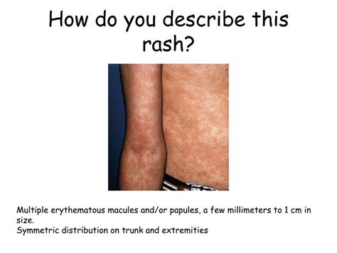 Ppt Fever And Rash Powerpoint Presentation Id6320033