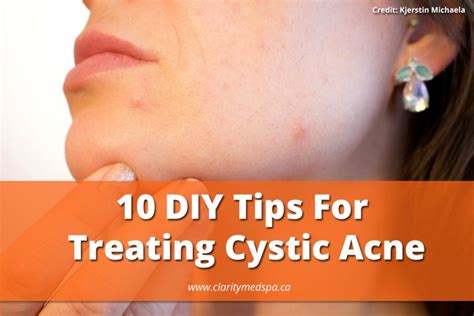 10 Diy Tips For Treating Cystic Acne That Really Work Clarity Medspa