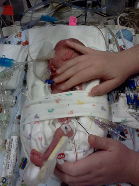 Premature Baby Journey Through The Nicu