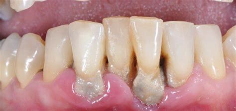 Gum Disease Treatment Symptoms Cost Recovery Etc