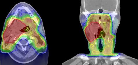 Head And Neck Cancer Radiation Therapy All About Radiation
