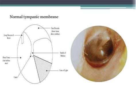 Acute Suppurative Otitis Media