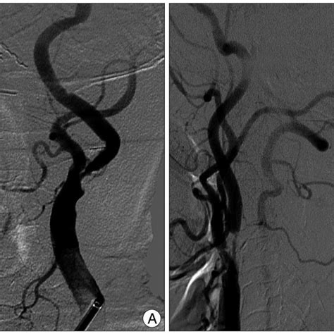 Magnetic Resonance Angiogram Showing High Grade Stenoses Of Both