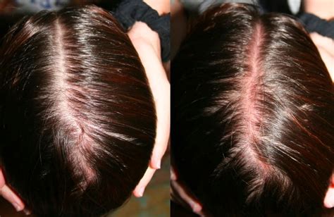Know All About Sunburn On Scalps And The Treatment