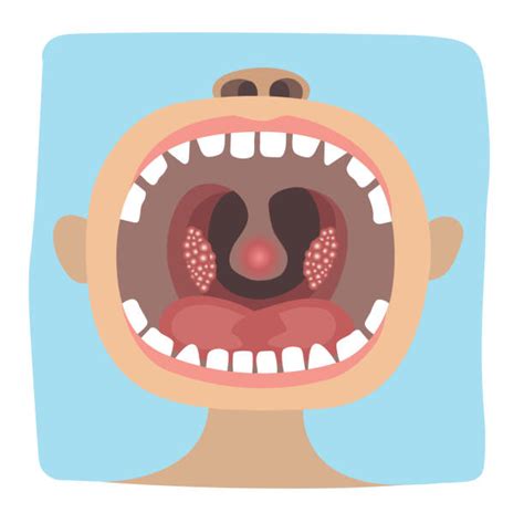 Pharyngitis Pic Illustrations Royalty Free Vector Graphics And Clip Art