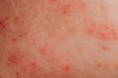 Chlorine Rash Symptoms Causes And Prevention