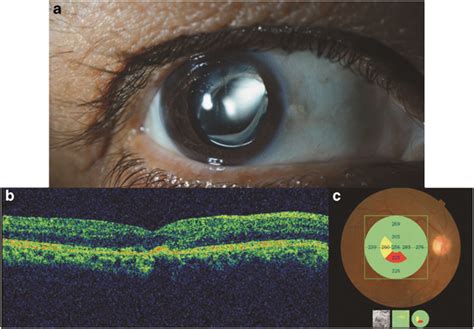 Anterior Segment Photograph Showing Posterior Chamber Intraocular Lens