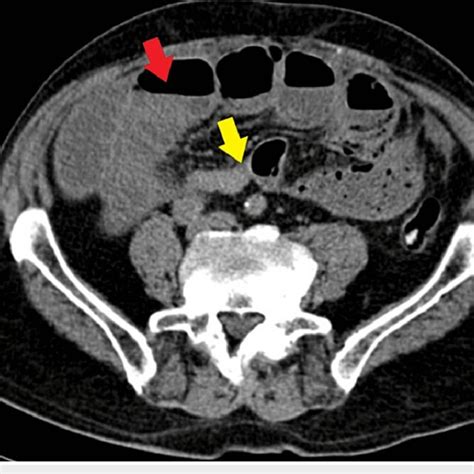Non Contrast Ct Scan Of The Abdomen Showing Air Fluid Levels In The