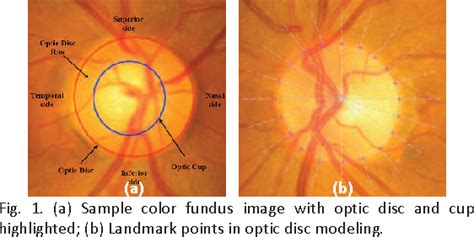 Figure 1 From Automated Segmentation Of Optic Disc And Optic Cup In