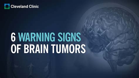 6 Warning Signs Of Brain Tumors Youtube
