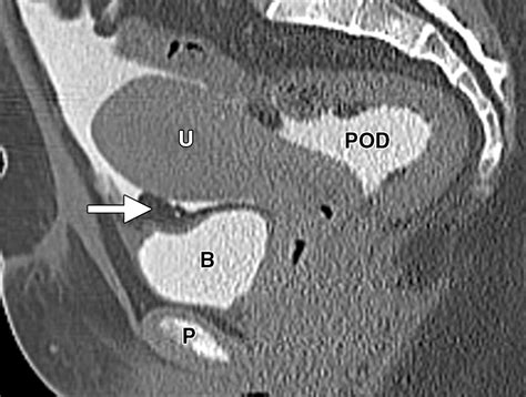 Peritoneal And Retroperitoneal Anatomy And Its Relevance For Cross