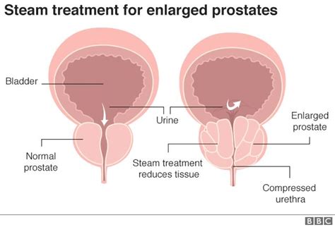 Steam Treatment For Big Prostates Approved On NHS BBC News