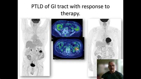 Fdg Pet In Uncommon Lymphomas Dr Simon Hughes Youtube